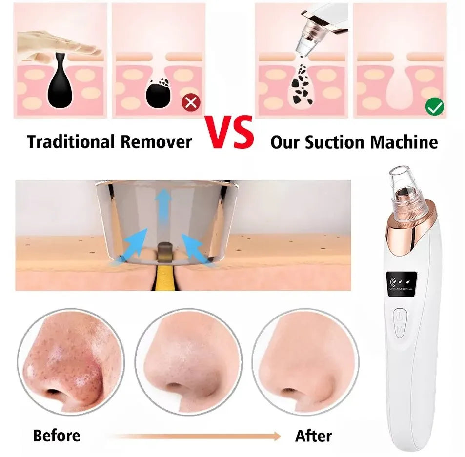5in1 Blackhead Remover Machine Rechargeable | Face Vacuum Derma Suction With 5 Heads | Blackhead Removing Machine 🛒 Order ➜ ⚙️ 1–2 Days Processing ➜ 🚚 Day 3 Delivered ✅